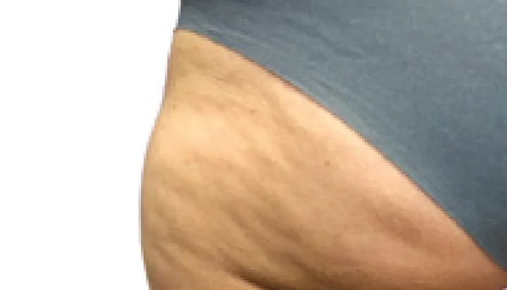 Apariencia de la celulitis antes del tratamiento