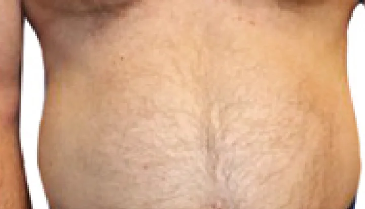 Antes y después NuEra Tight contorno corporal: antes
