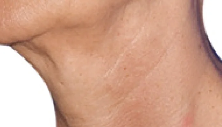 Arrugas del cuello después del tratamiento