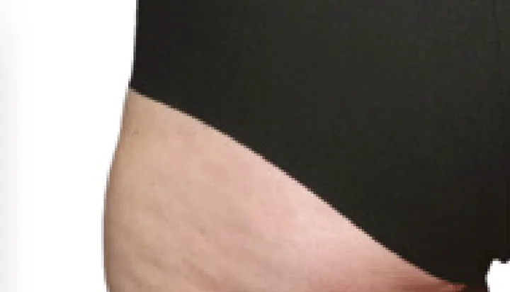 Apariencia de la celulitis después del tratamiento