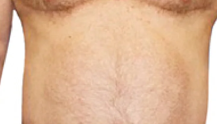 Antes y después NuEra Tight contorno corporal: después