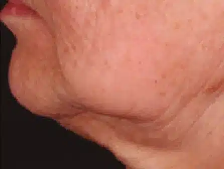Antes del tratamiento con EndyMed PURE 2.0: línea mandibular