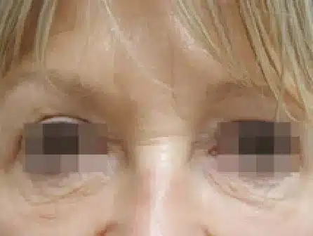 Antes del tratamiento con EndyMed PURE 2.0: contorno de ojos