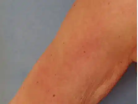 Después del tratamiento con EndyMed PURE 2.0: brazo