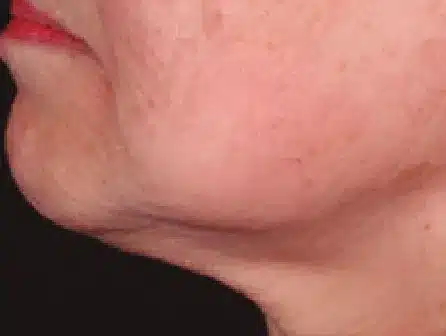 Después del tratamiento con EndyMed PURE 2.0: línea mandibular