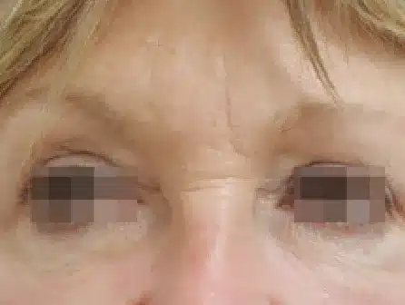 Después del tratamiento con EndyMed PURE 2.0: contorno de ojos