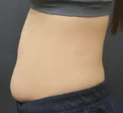 Antes del tratamiento con SCIZER: abdomen