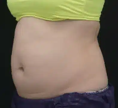 Antes del tratamiento con SCIZER: abdomen