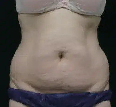 Antes del tratamiento con SCIZER: abdomen y flancos