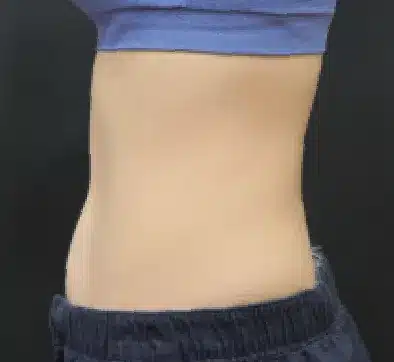 Después del tratamiento con SCIZER: abdomen