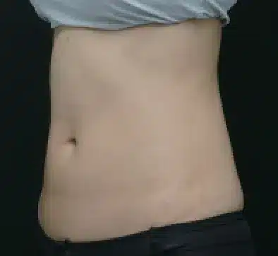 Después del tratamiento con SCIZER: abdomen