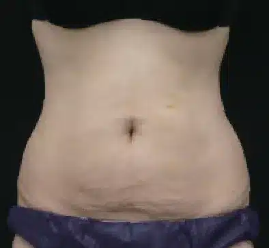 Después del tratamiento con SCIZER: abdomen y flancos