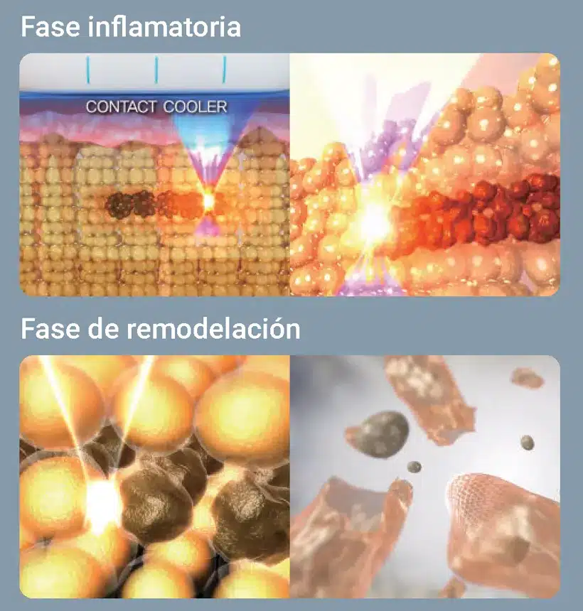 Fase inflamatoria y fase de remodelación del tratamiento SCIZER