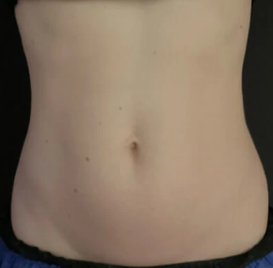 Antes del tratamiento con triLift Lumenis: abdomen