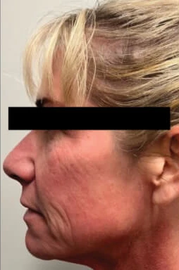 Antes del tratamiento con triLift Lumenis: arrugas