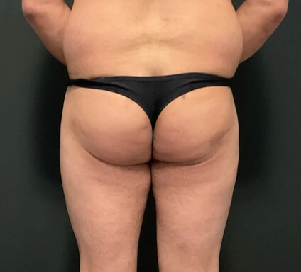 Antes del tratamiento con triLift Lumenis: celulitis