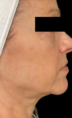 Antes del tratamiento con triLift Lumenis: cuello y mandíbula
