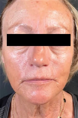 Antes del tratamiento con triLift Lumenis: rostro