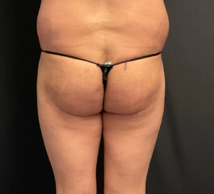 Después del tratamiento con triLift Lumenis: celulitis
