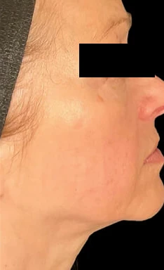 Después del tratamiento con triLift Lumenis: cuello y mandíbula