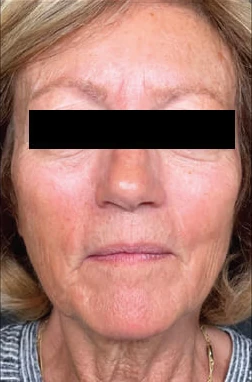 Después del tratamiento con triLift Lumenis: rostro